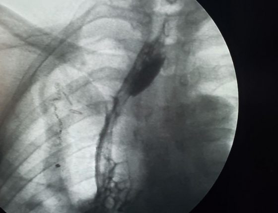 Рентген контрастирования зоны анастомоза на 5 сутки после операции